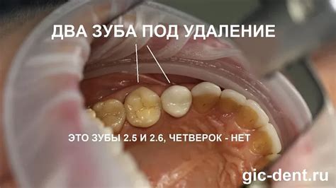 Использование зуба