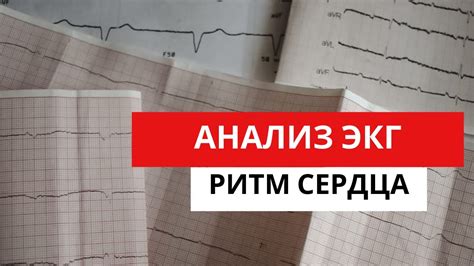 Определение ритма на ЭКГ