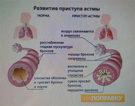 Основные методы лечения астмы