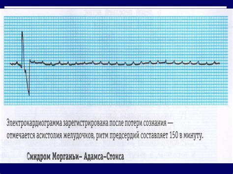 Основные методы определения ритма на ЭКГ