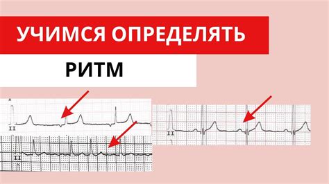 Ритм на ЭКГ - основные понятия и значение