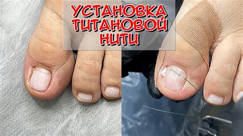 Установка нити
